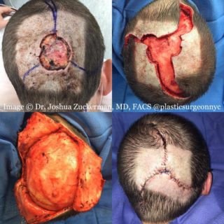 Four images representation before, during surgery, and immediately after surgery for a complex plastic surgery scalp reconstruction that Dr. Zuckerman performed in New York City.